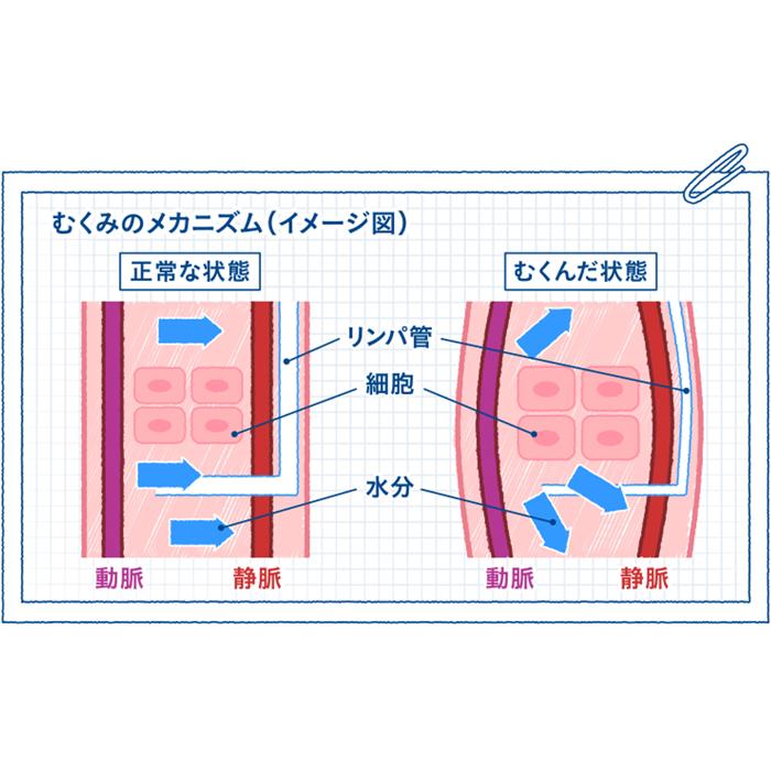 【SMサイズ】スリムウォーク メディカルリンパ（ストッキング） 着圧 美脚 ピップ むくみ 商品画像2：HOTMART PLUS